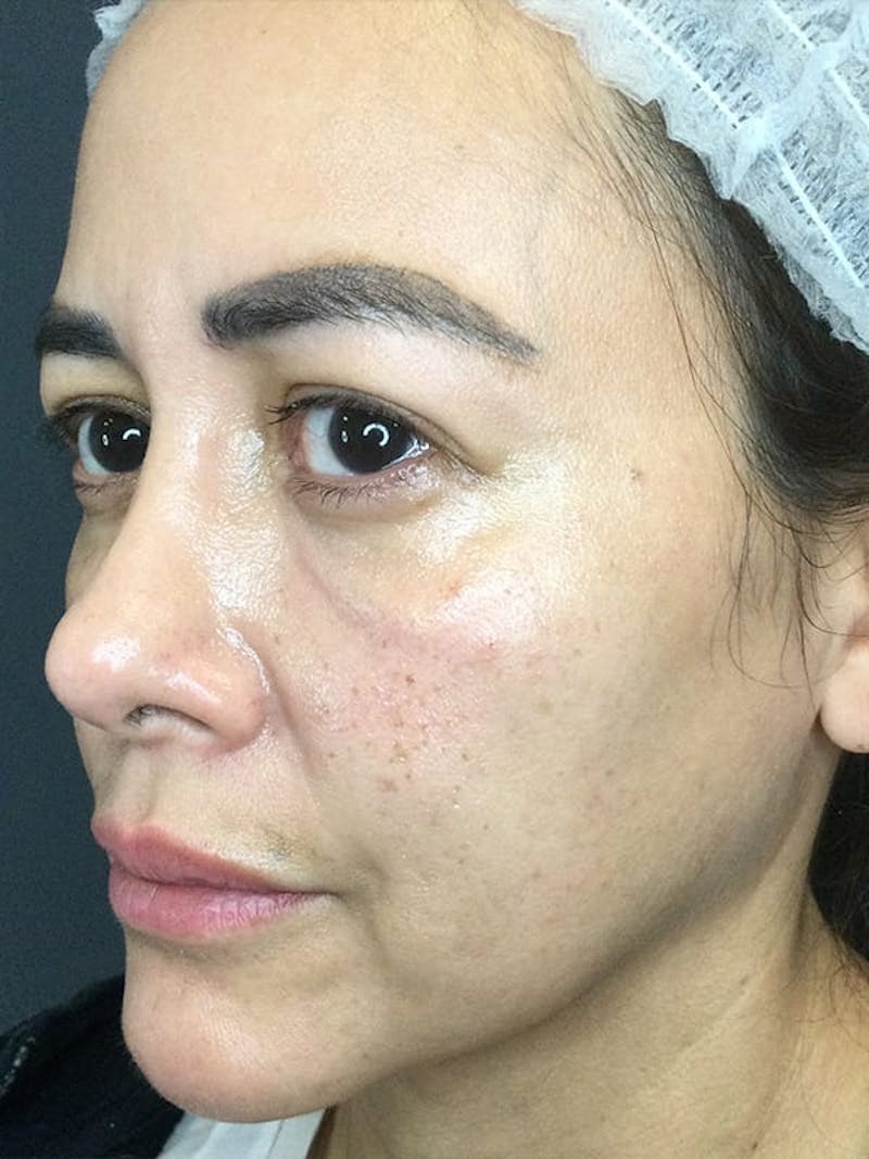 Dermal Fillers Before & After Gallery - Patient 976688 - Image 5