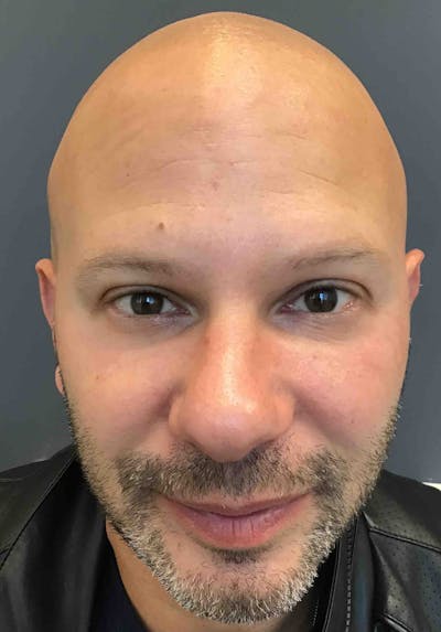 Dermal Fillers Before & After Gallery - Patient 101547 - Image 2
