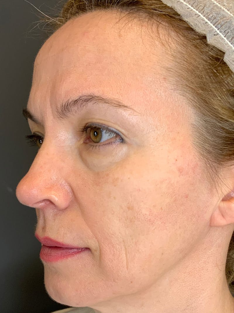 Dermal Fillers Before & After Gallery - Patient 402126 - Image 1