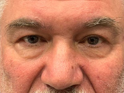 Blepharoplasty Before & After Gallery - Patient 287935 - Image 1