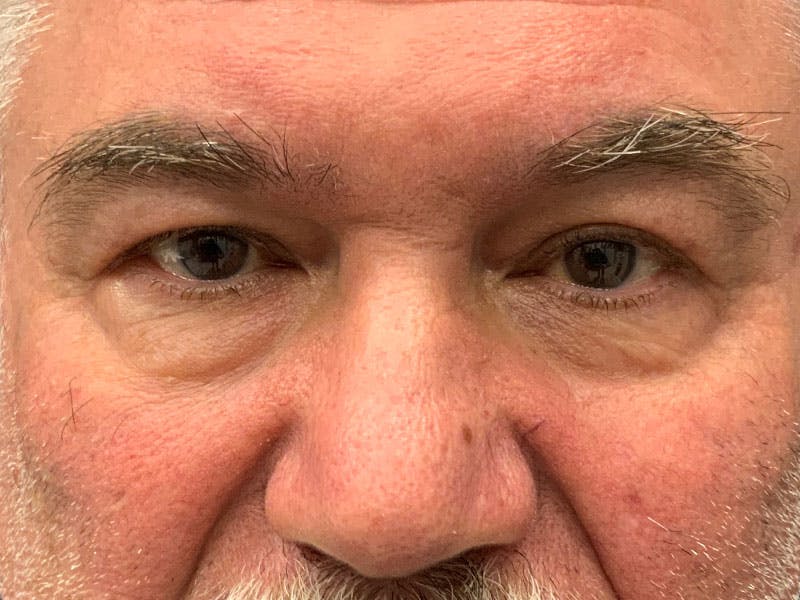 Blepharoplasty Before & After Gallery - Patient 287935 - Image 1