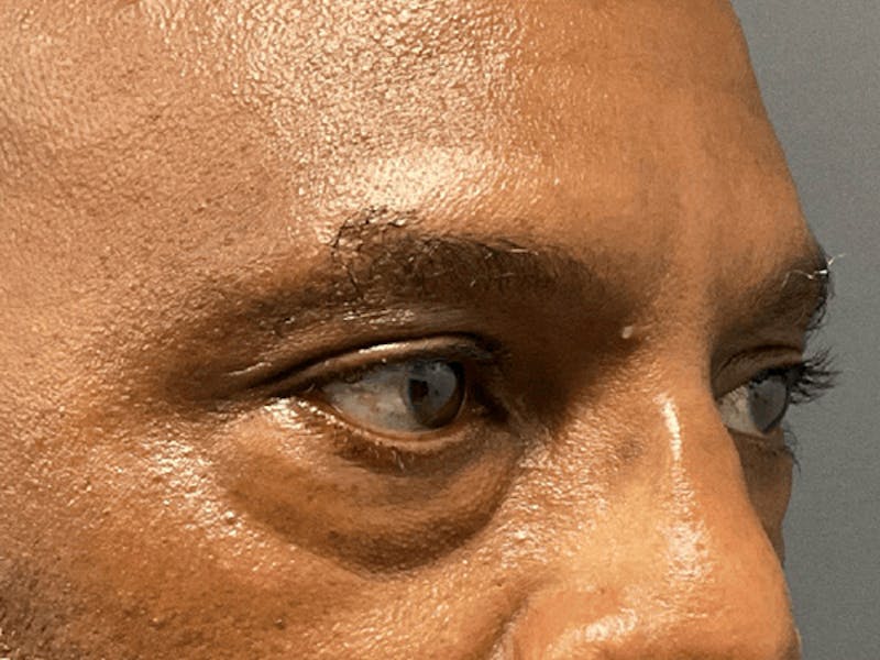 Blepharoplasty Before & After Gallery - Patient 326511 - Image 3