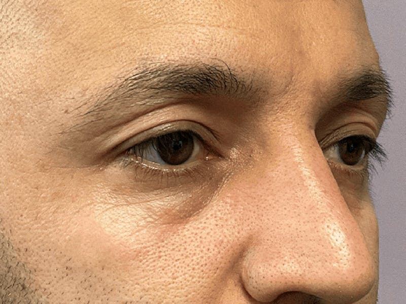 Blepharoplasty Before & After Gallery - Patient 278046 - Image 5