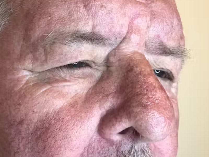 Blepharoplasty Before & After Gallery - Patient 286607 - Image 3
