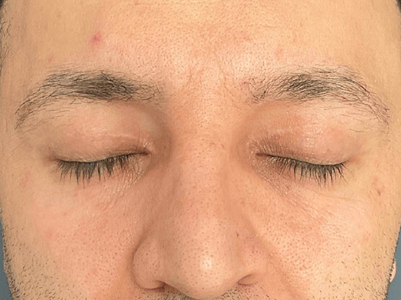 Blepharoplasty Before & After Gallery - Patient 278046 - Image 4
