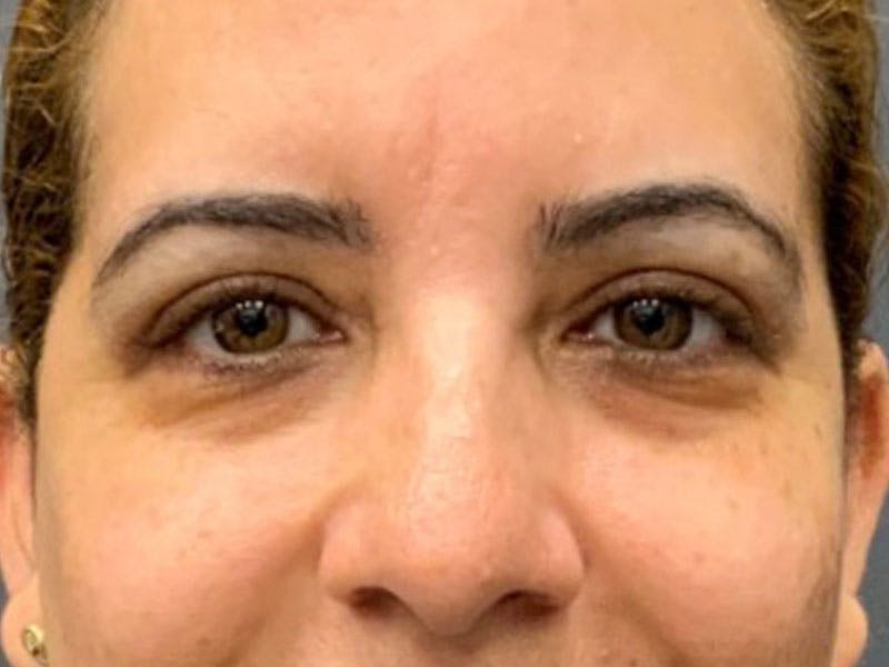 Blepharoplasty Before & After Gallery - Patient 246857 - Image 4