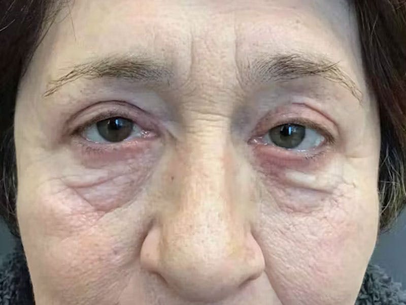 Blepharoplasty Before & After Gallery - Patient 187426 - Image 2