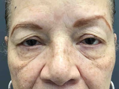 Blepharoplasty Before & After Gallery - Patient 460585 - Image 1