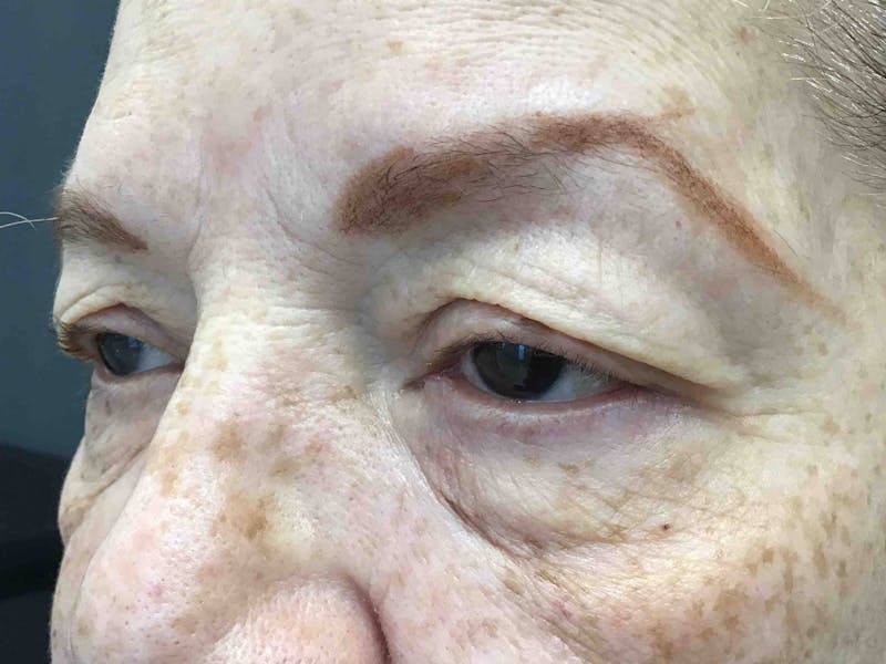 Blepharoplasty Before & After Gallery - Patient 460585 - Image 3