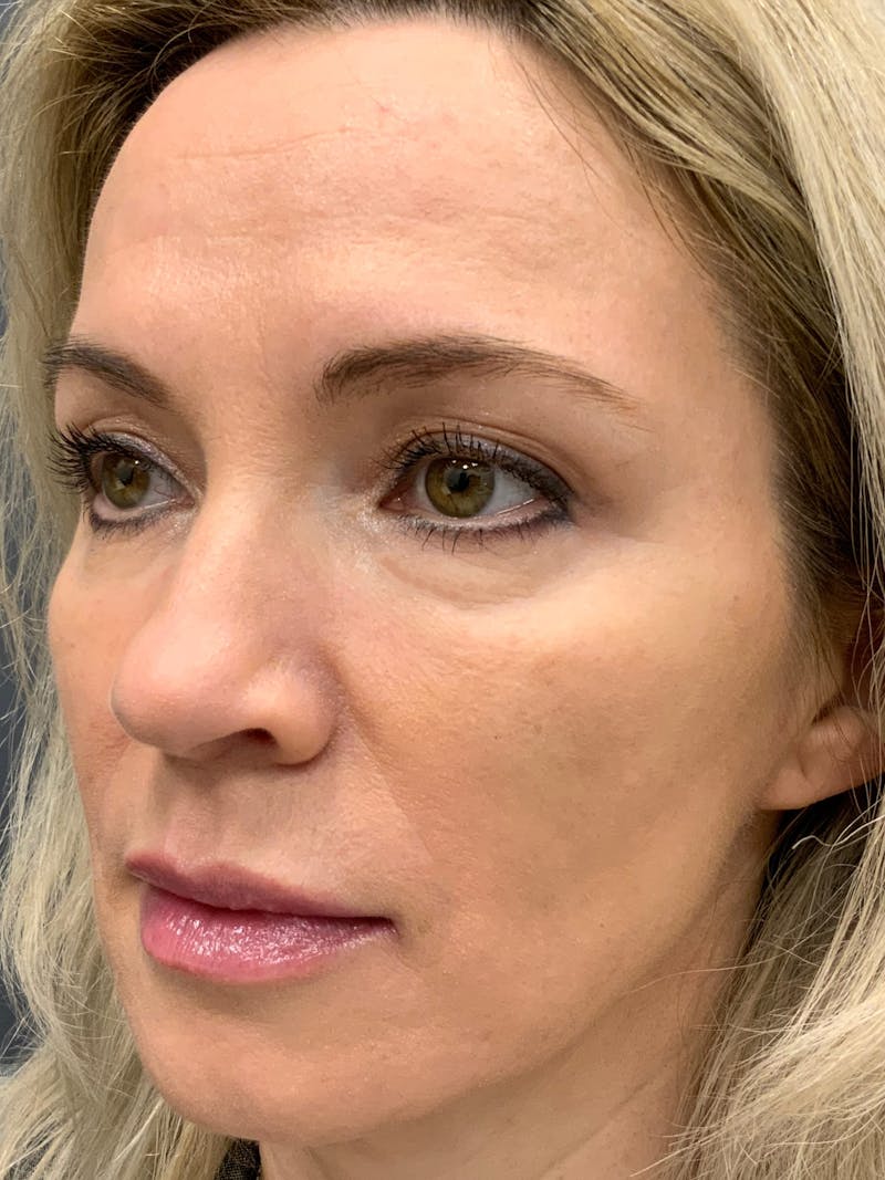 Dermal Fillers Before & After Gallery - Patient 402126 - Image 2