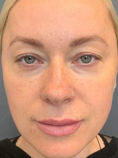 Morpheus8 Before & After Gallery - Patient 332637 - Image 1