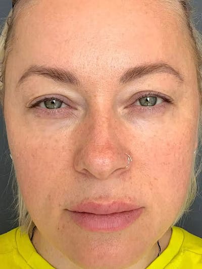 Morpheus8 Before & After Gallery - Patient 332637 - Image 2