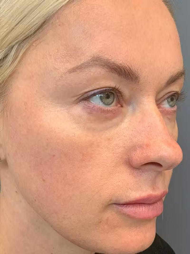 Morpheus8 Before & After Gallery - Patient 332637 - Image 5