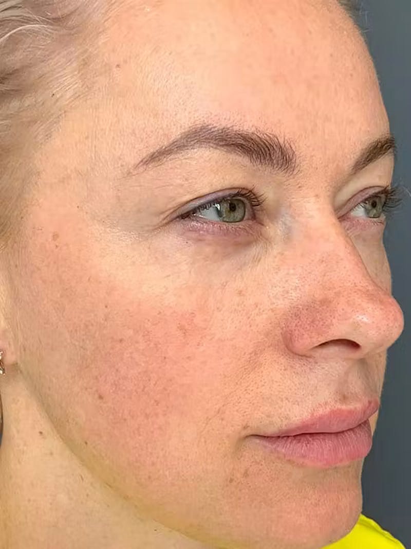 Morpheus8 Before & After Gallery - Patient 332637 - Image 6