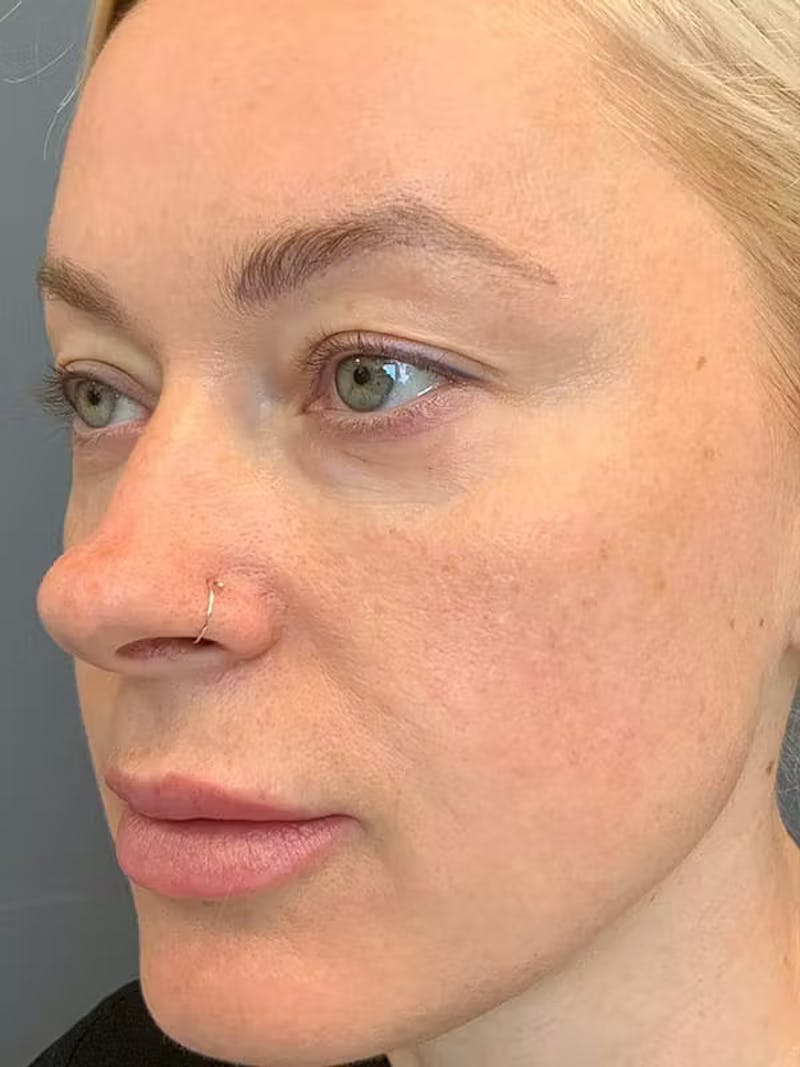 Morpheus8 Before & After Gallery - Patient 332637 - Image 3