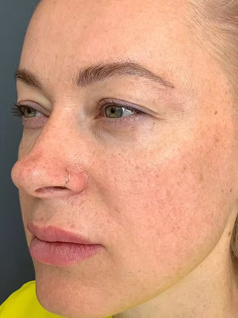 Morpheus8 Before & After Gallery - Patient 332637 - Image 4