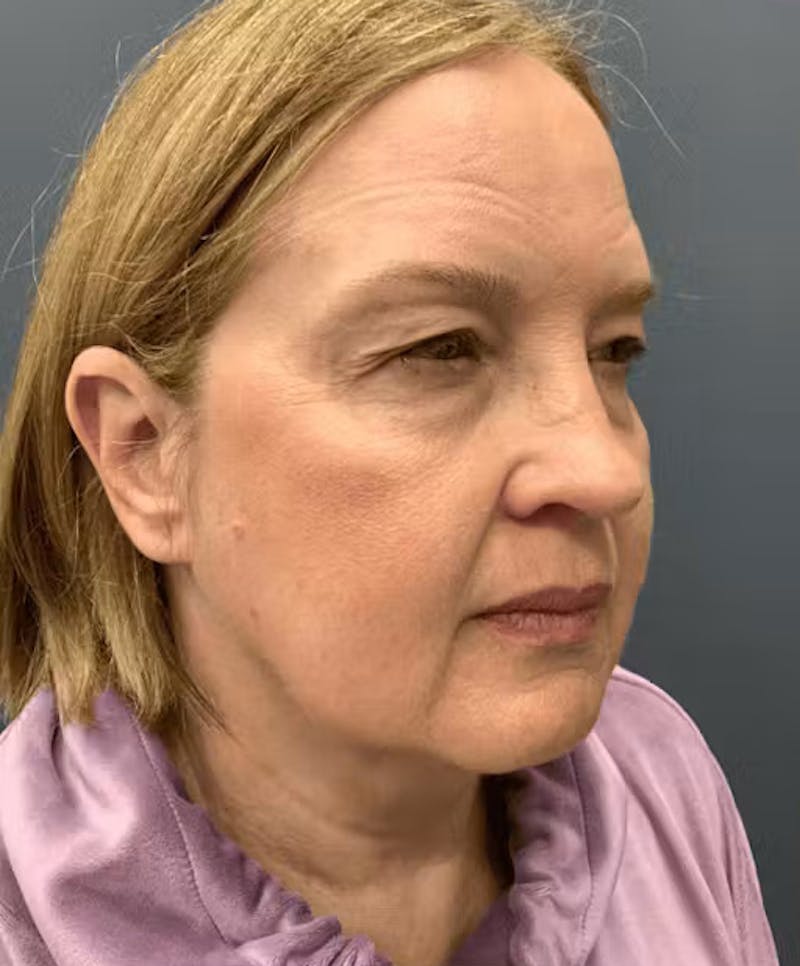 Thread Lift Before & After Gallery - Patient 817151 - Image 5