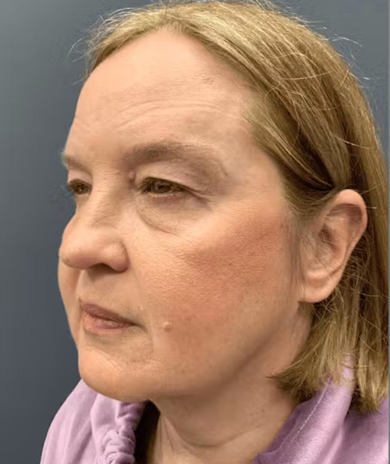 Thread Lift Before & After Gallery - Patient 817151 - Image 3