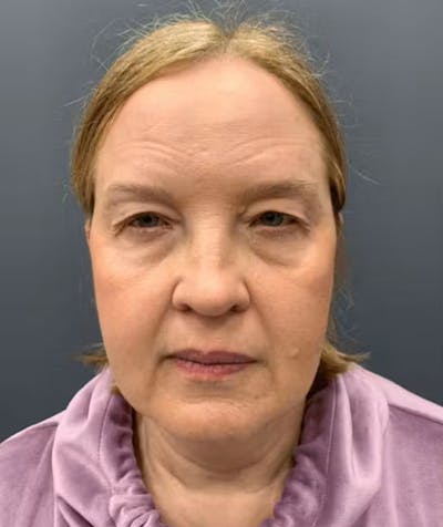 Thread Lift Before & After Gallery - Patient 817151 - Image 1