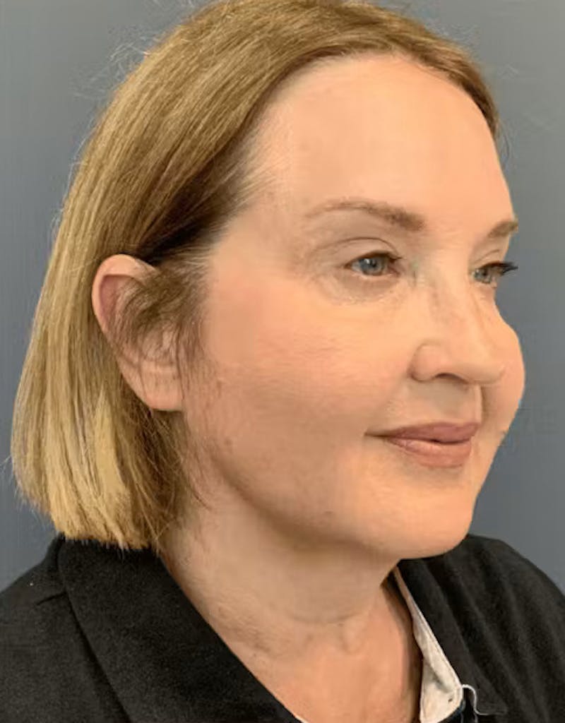 Thread Lift Before & After Gallery - Patient 817151 - Image 6