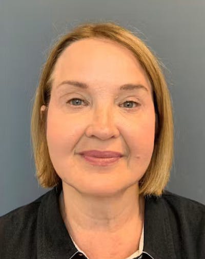 Thread Lift Before & After Gallery - Patient 817151 - Image 2
