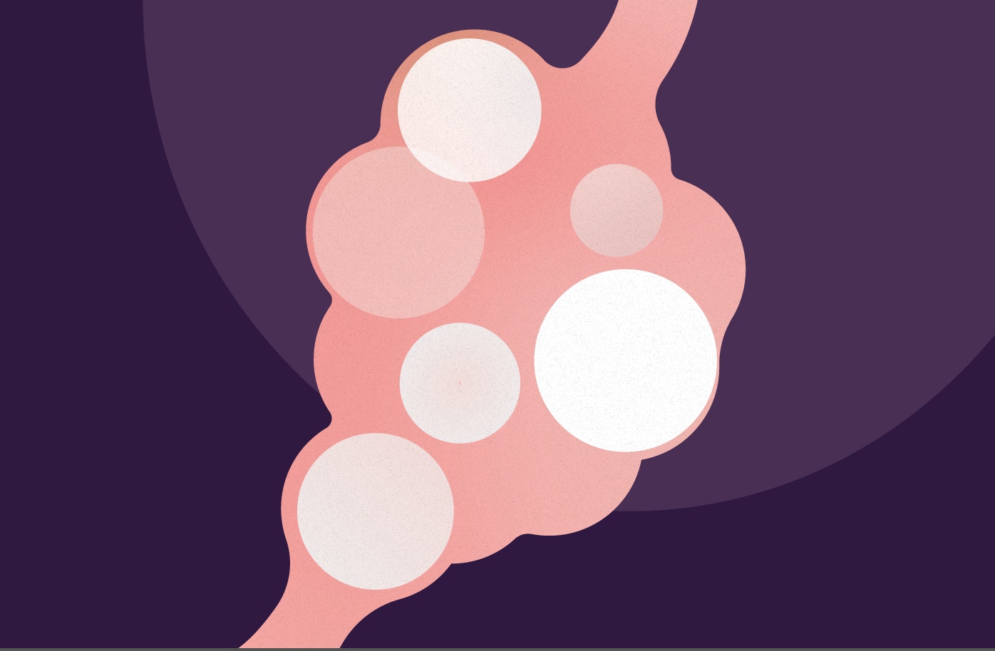 Illustration av en äggstock med PCOS
