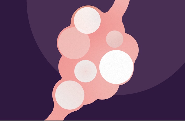 Illustration av en äggstock med PCOS