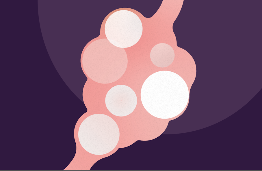 Illustration of an ovary with PCOS