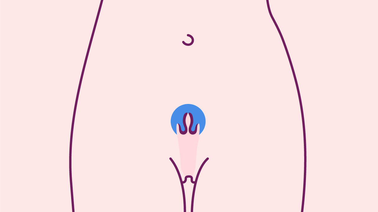图示女性躯干轮廓，突出显示阴道和子宫颈