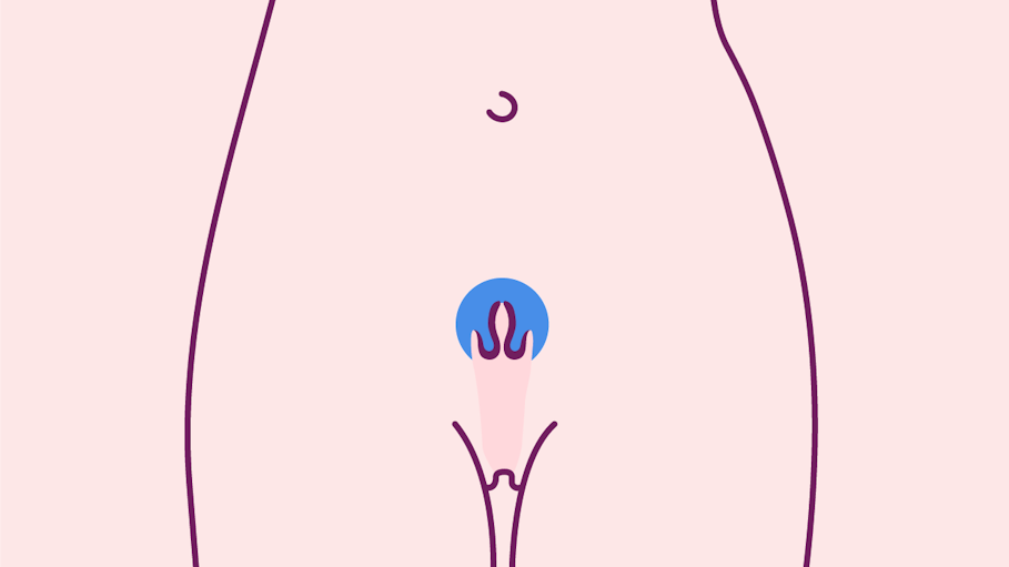 Illustrated outline of a female torso showing the vagina and cervix highlighted