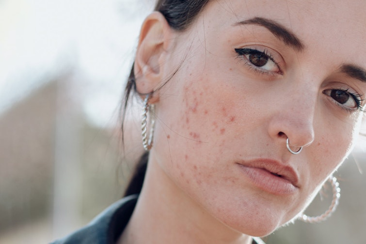 Headshot of woman with acne with hoop earings and a nose piercing