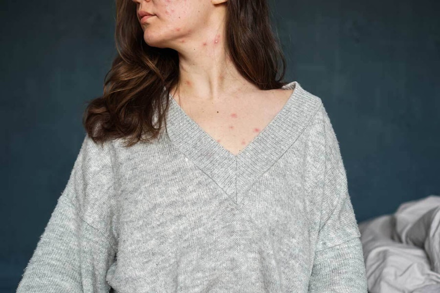 Woman in grey jumper with hair over her shoulder, showing acne on face, neck and chest.