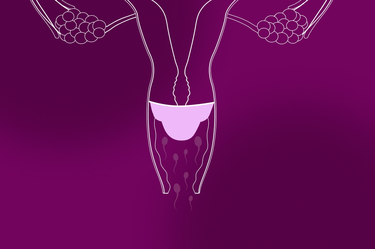 Illustration of a uterus with the cervical cap inserted