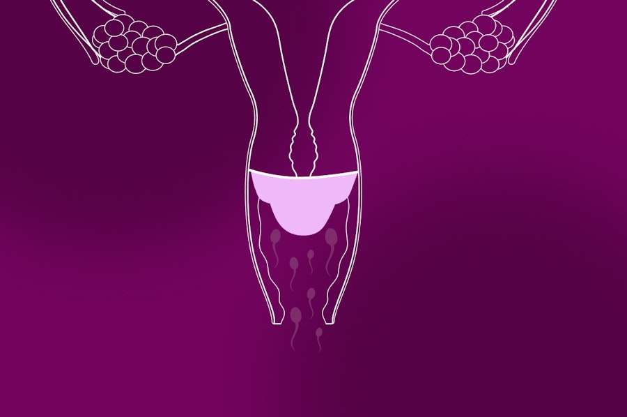 Illustration of a uterus with the cervical cap inserted