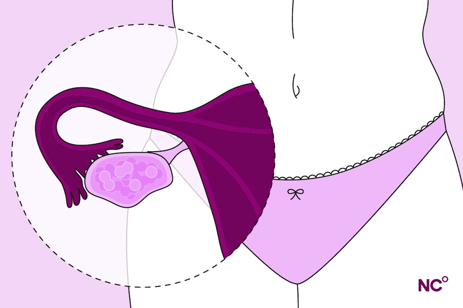 Illustration of a woman's stomach zoomed in and showing a window into the left hand fallopian tubes and ovary