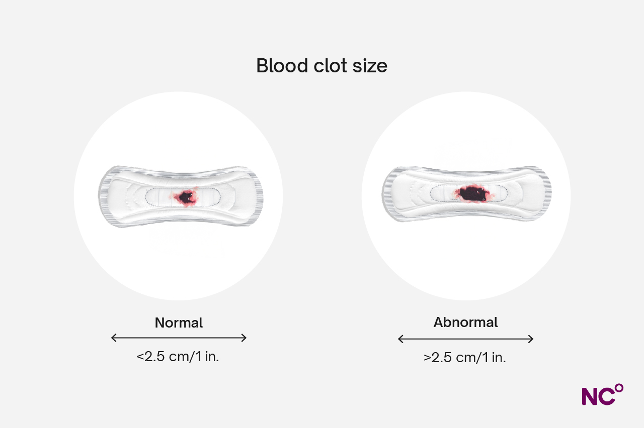 Two pads with period blood clots on them showing a comparison of one abnormal period blood clot that's larger than 2.5 cm and one normal one that's smaller