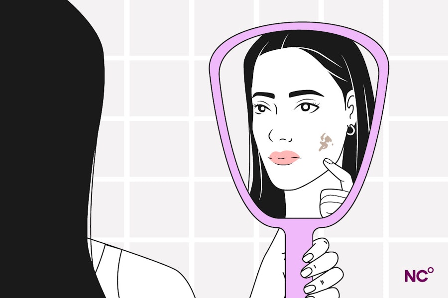 Illustration of a woman looking in a mirror showing facial melasma