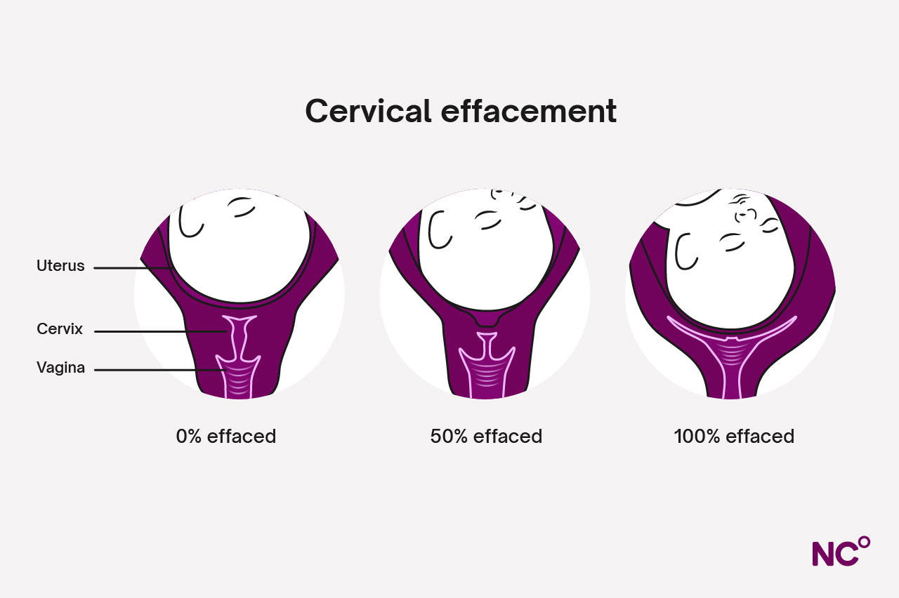 Diagram showing percentage of effacement 
