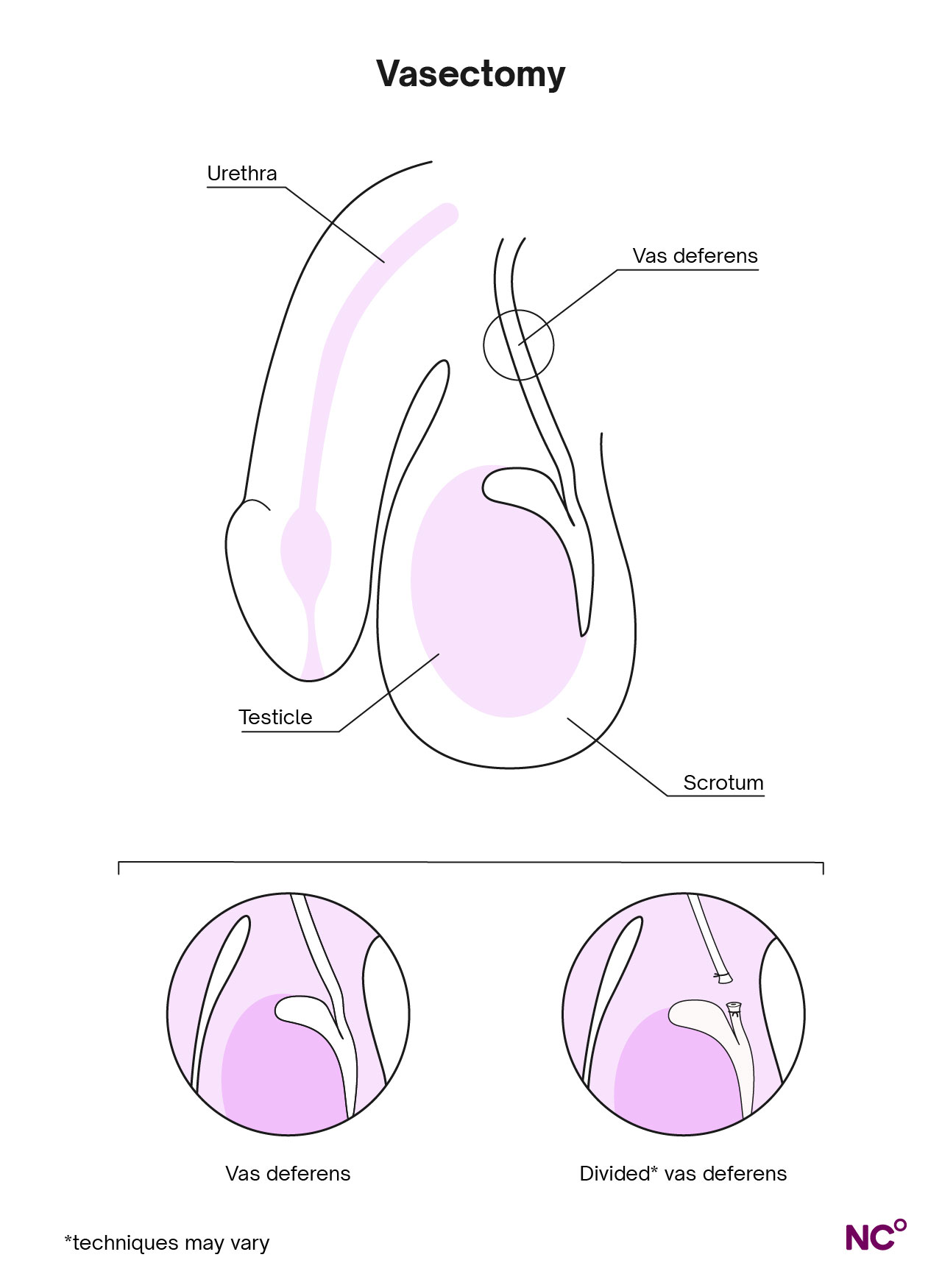 Vasechtomy procedure illustration