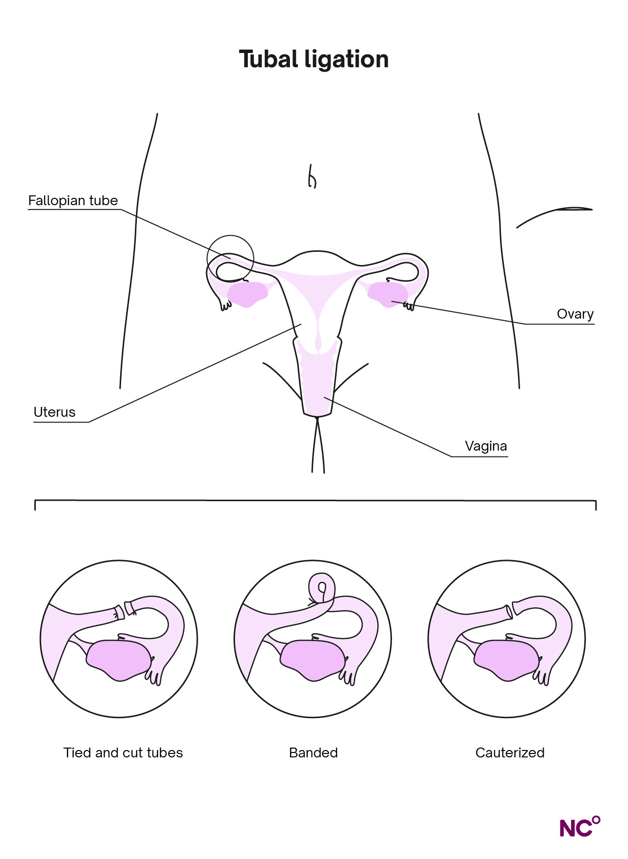 Tubal ligation procedure