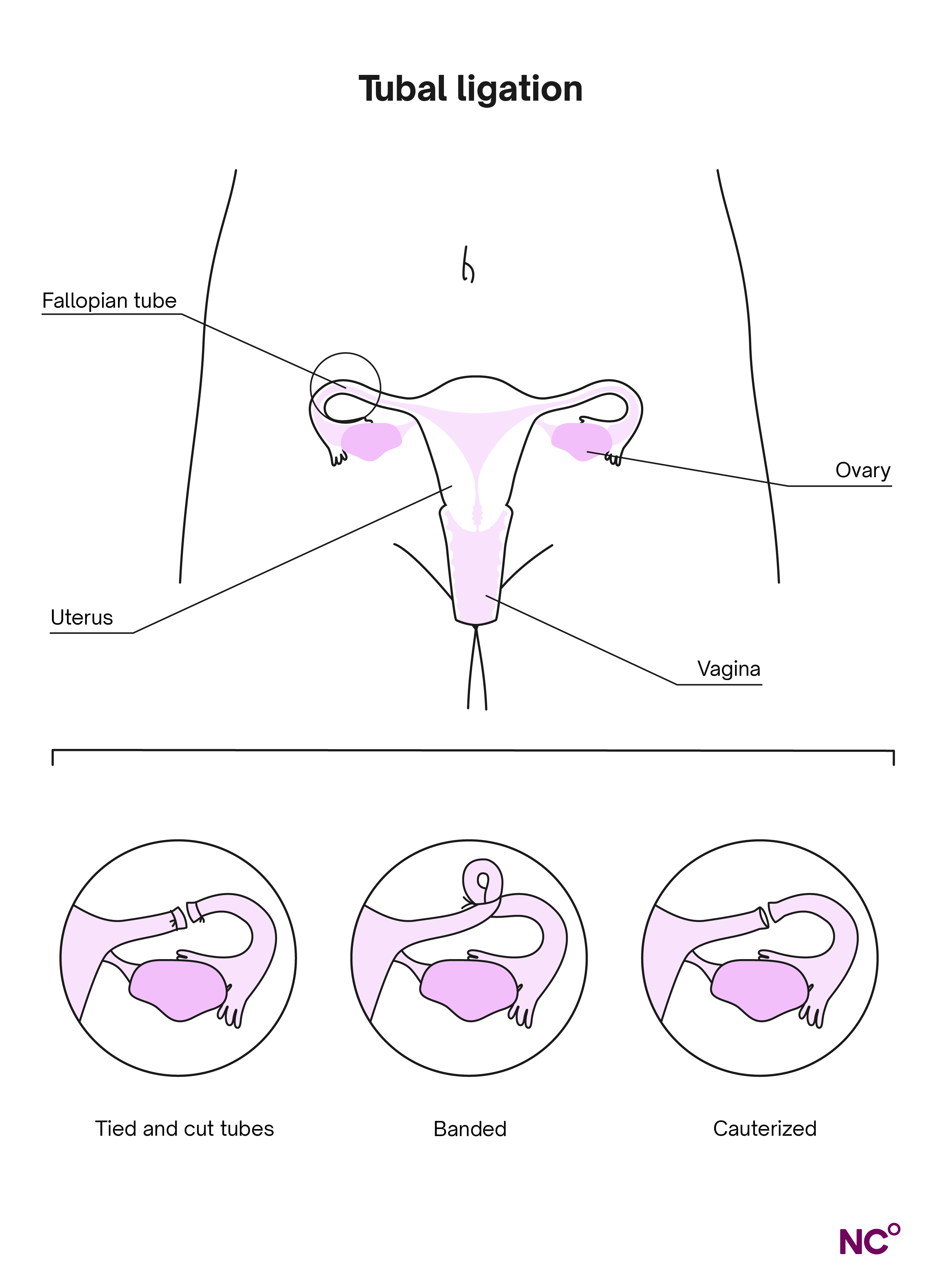 Infographic showing the different types of tubal ligation and how they relate to the female reproductive system