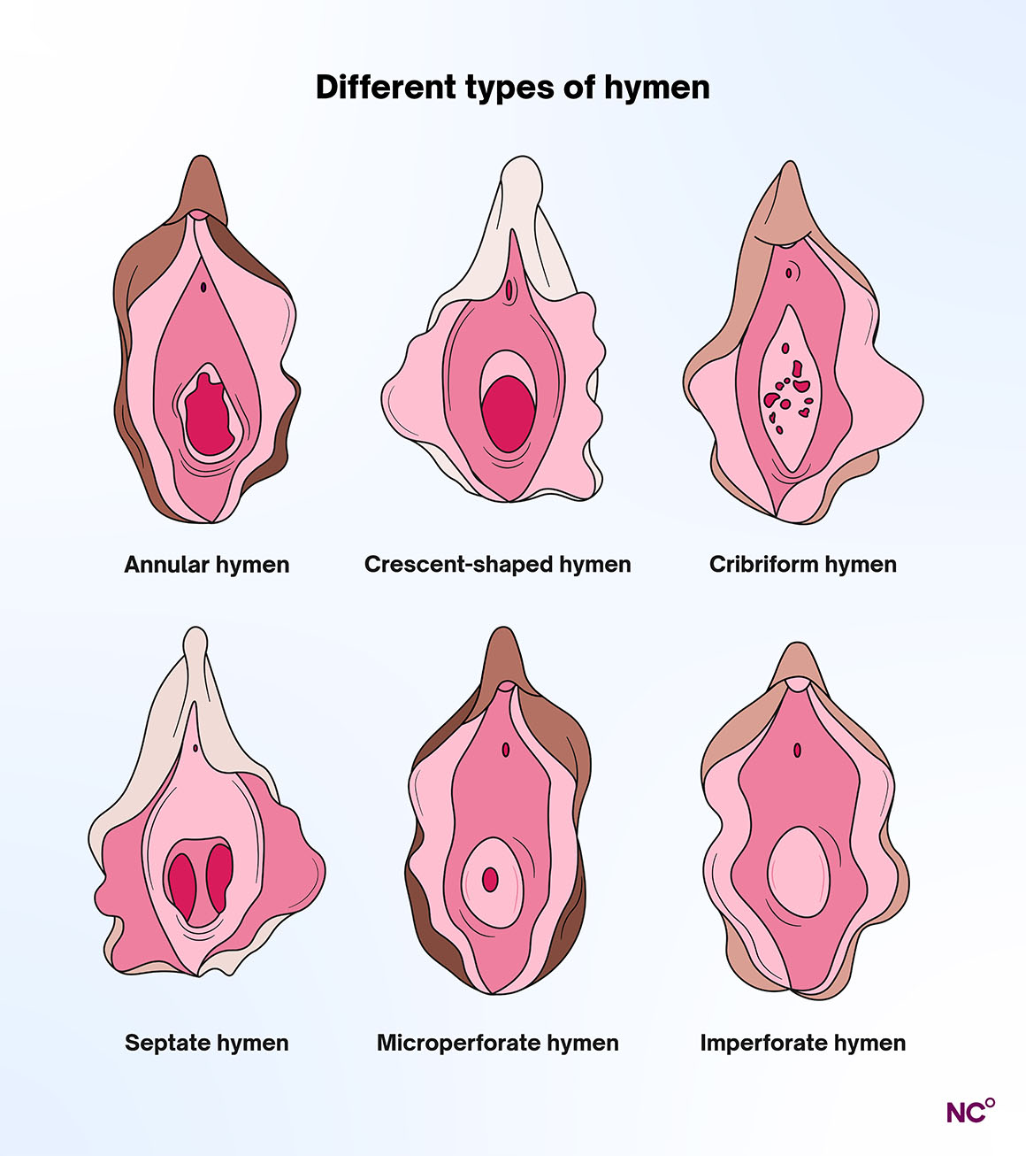 Infographic showing different hymen types