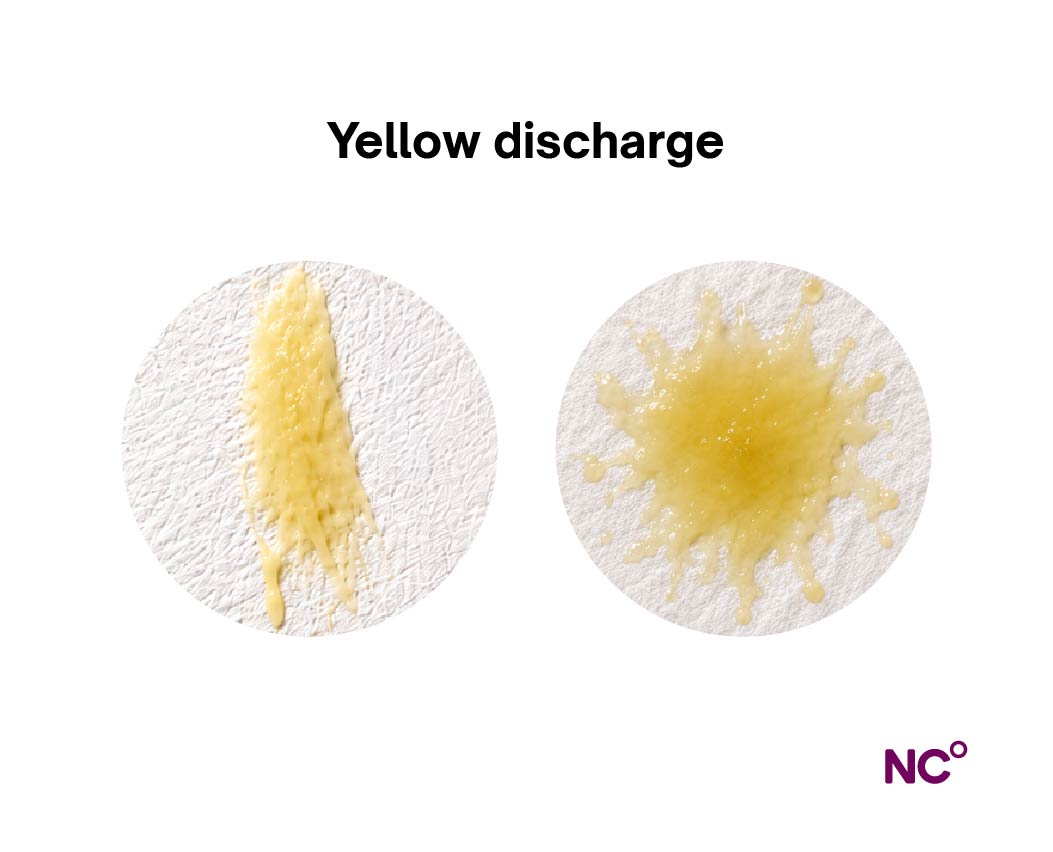 Realistic image of what yellow discharge looks like
