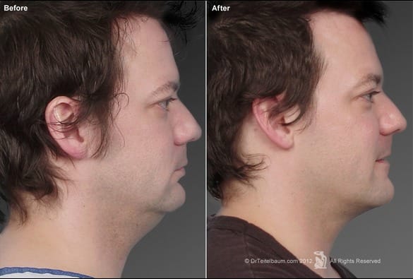 male facelift results