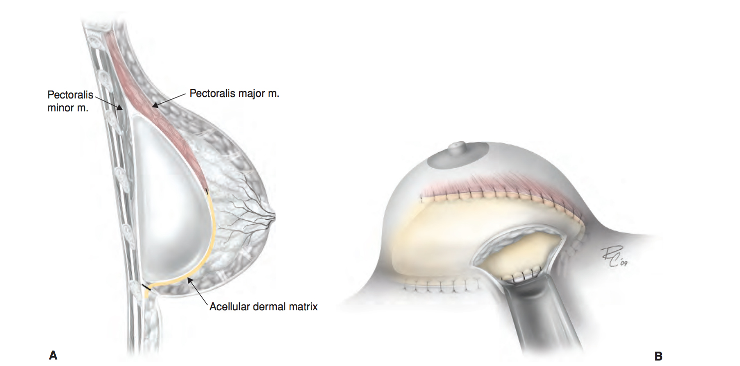 Illustration of the placement of Strattice