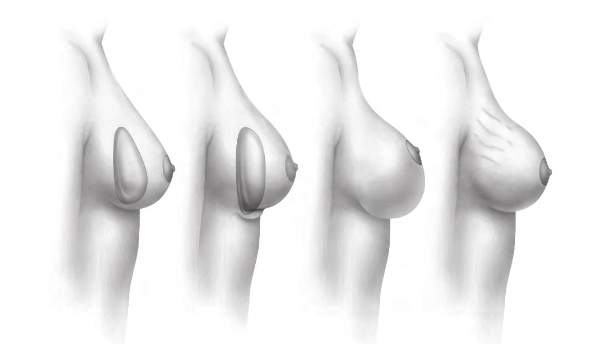 breast rippling illustration