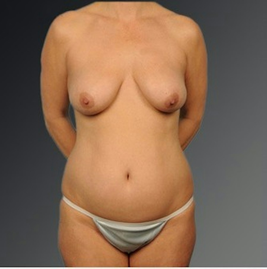 Patient 116798058 | Front View | Before | Mommy Makeover — Steven Teitelbaum MD -