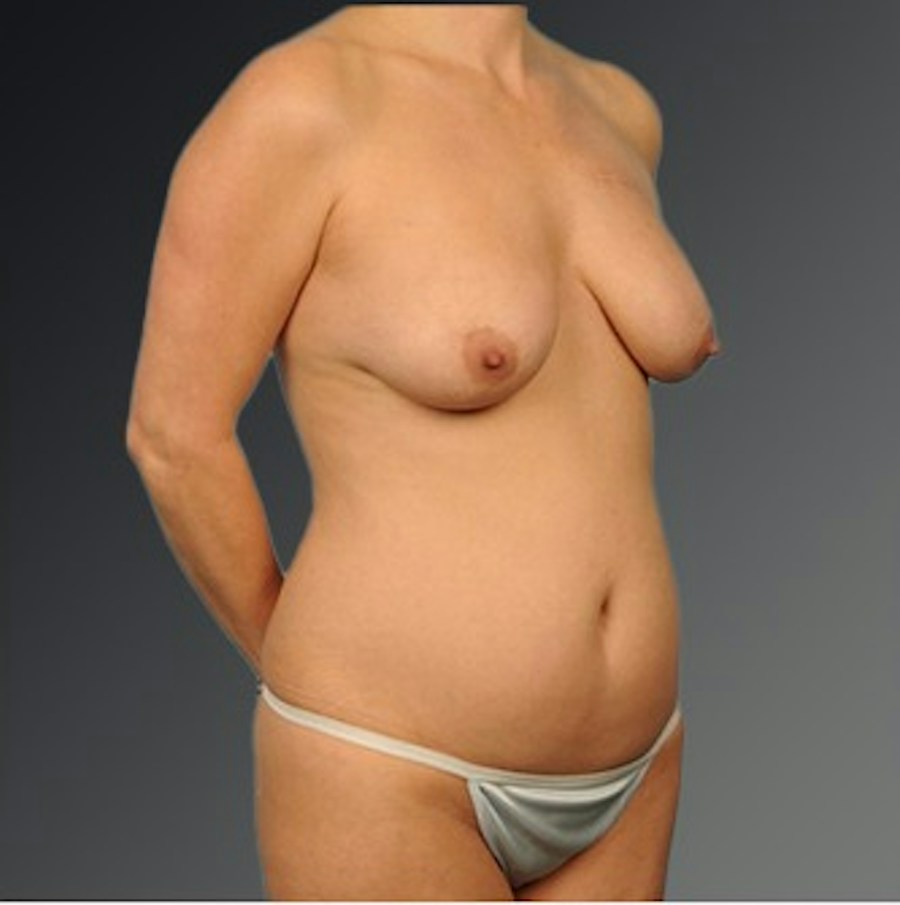 Patient 116798058 | Angle View | Before | Mommy Makeover — Steven Teitelbaum MD -