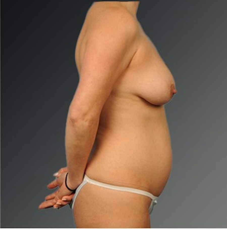 Patient 116798058 | Profile View | Before | Mommy Makeover — Steven Teitelbaum MD -