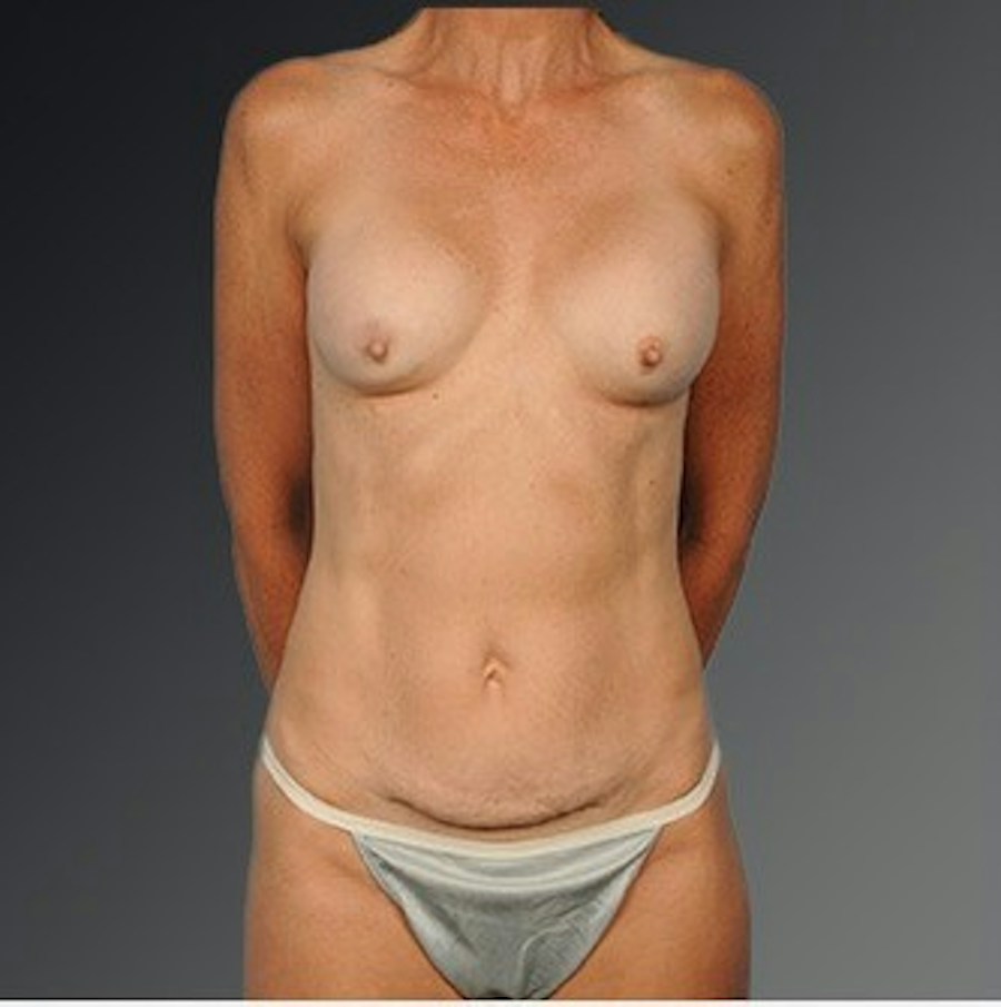 Patient 105714130 | Front View | Before | Mommy Makeover — Steven Teitelbaum MD -
